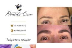scoatere-tatuaje-2