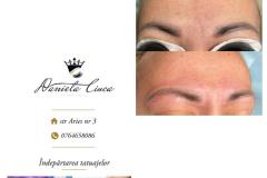 scoatere-tatuaje-3